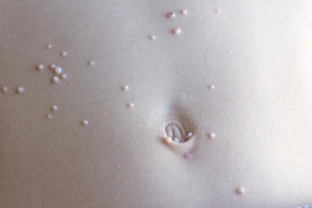 papilloma vírus, amint megjelenik férgeket kezelő csecsemők
