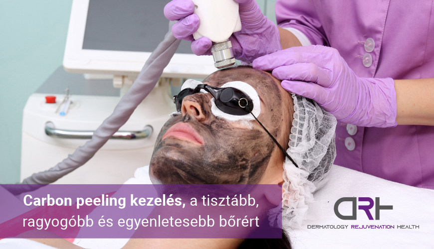 Carbon peeling kezelés