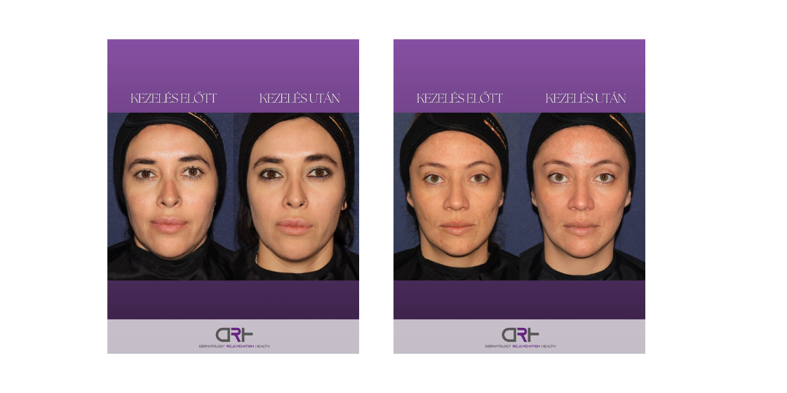 Ultherapy Prime előtte-utána