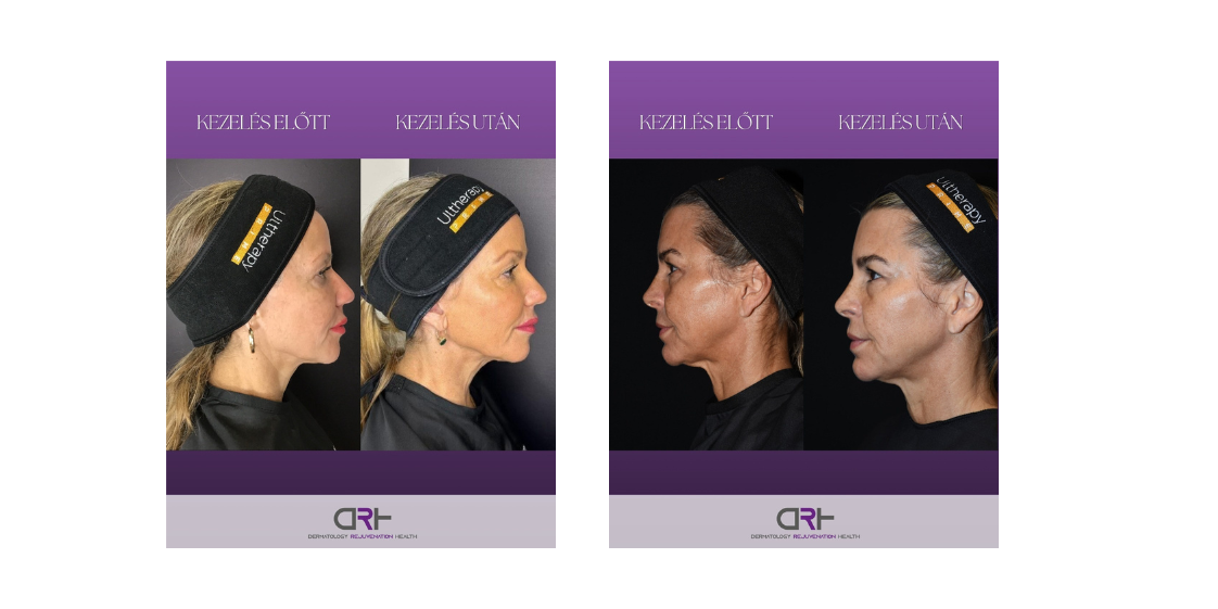 Ultherapy Prime előtte-utána