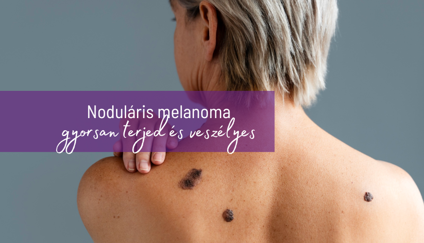 Noduláris melanoma 