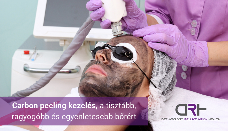 Carbon peeling kezelés