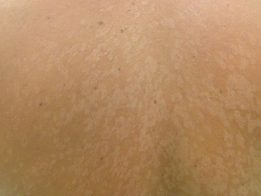 A bőrgomba tünetei és hajlamosító tényezői